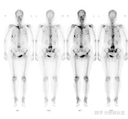 癌症火化骨頭|刚刚看到一个现代名医讲到他在观察自己癌症患者死后，肿瘤在火。